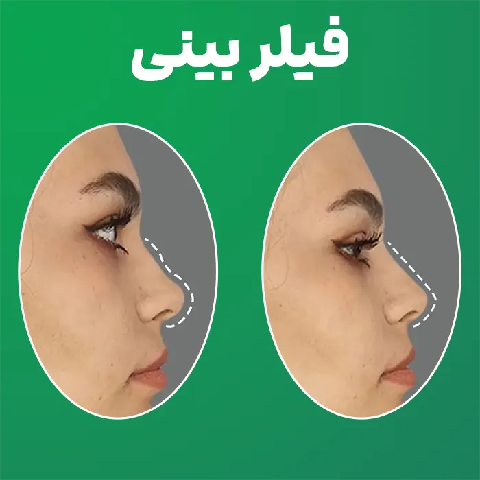فیلر بینی