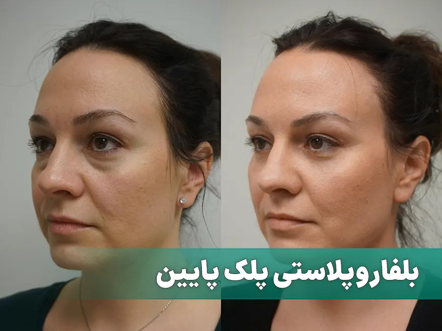 بلفاروپلاستی پلک پایین