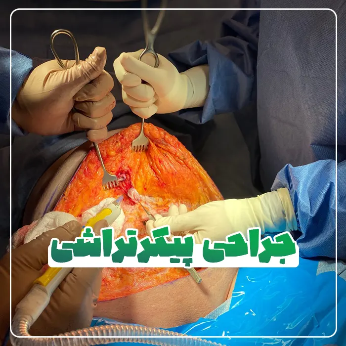 جراحی پیکرتراشی
