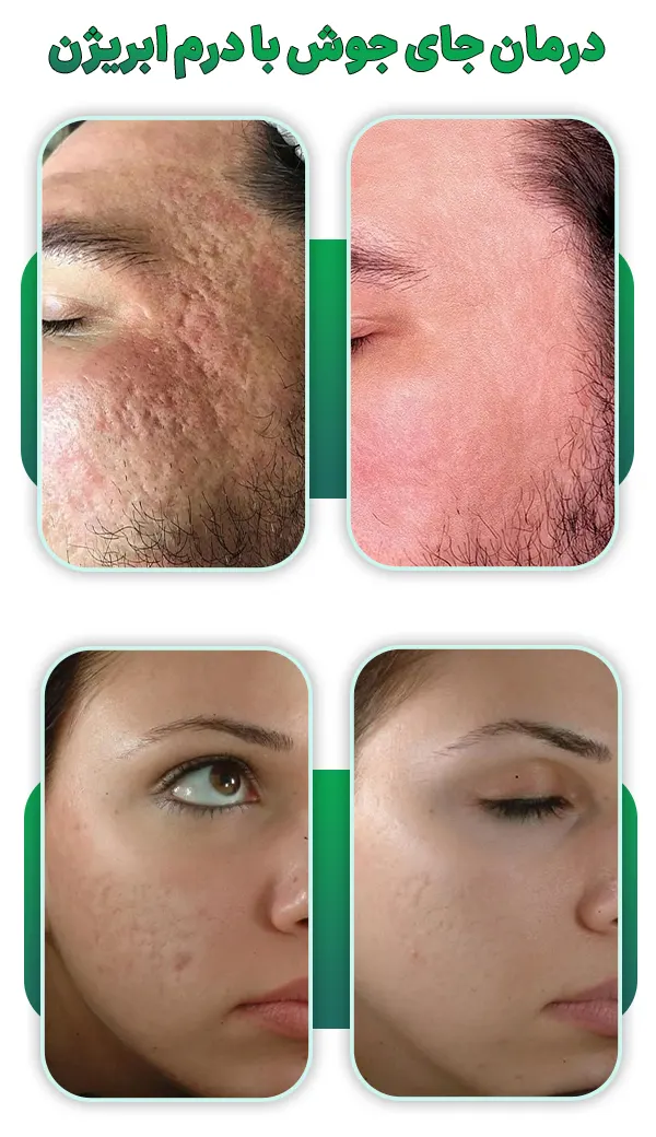 درمان جای جوش با درم ابریژن