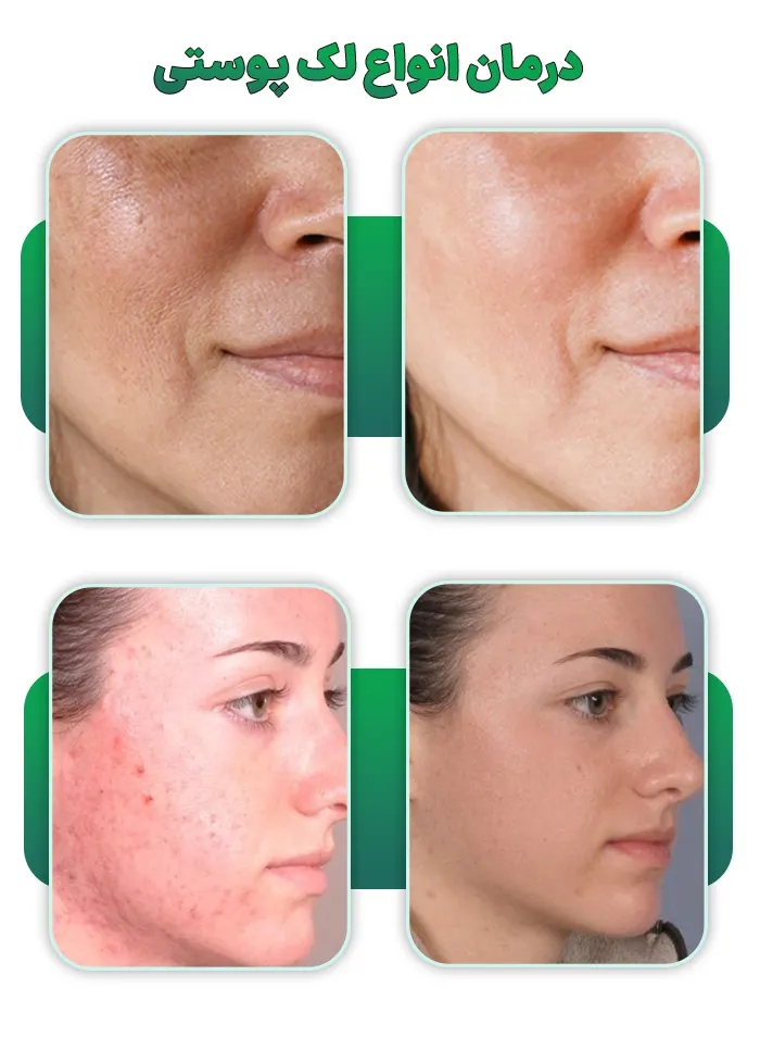 درمان لک پوستی