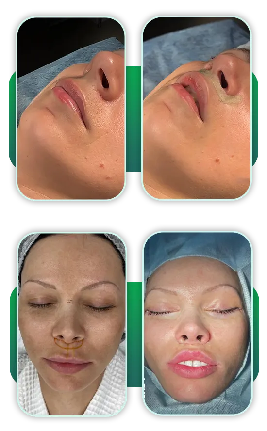 قبل بعد سانترال لب