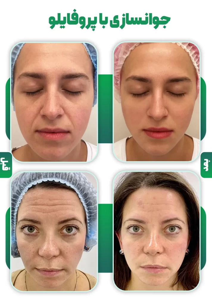 قبل بعد پروفایلو جوانساز