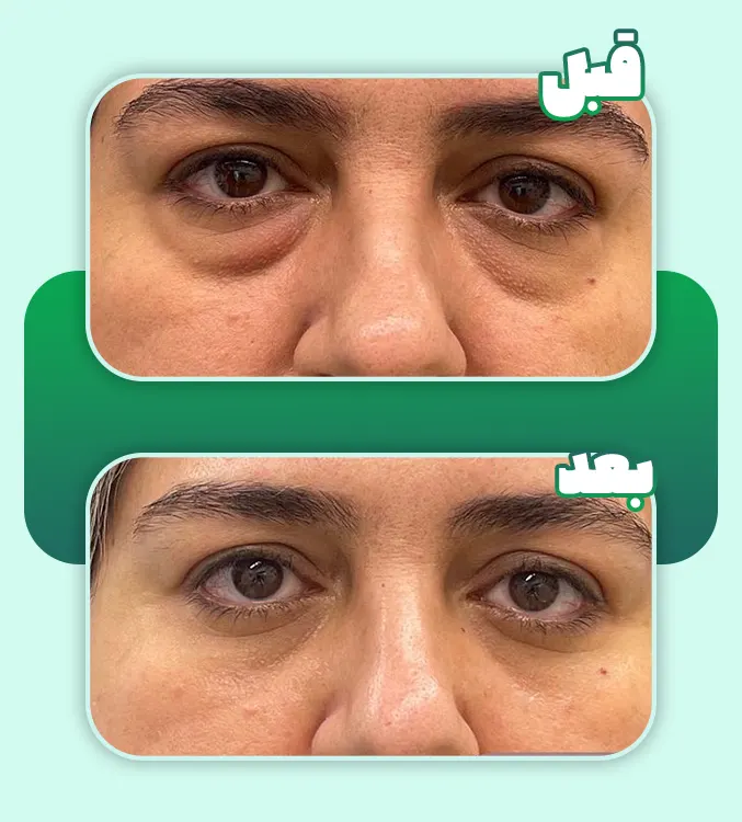 قبل و بعد بلفارو پلک پایین