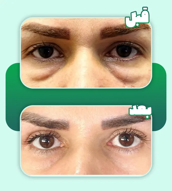 قبل و بعد بلفارو پلک پایین