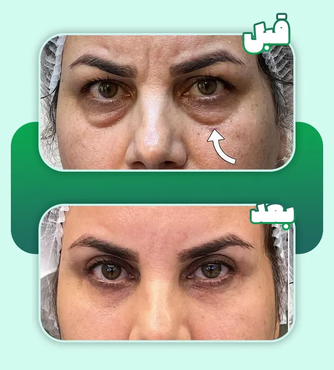 قبل و بعد بلفارو پلک پایین