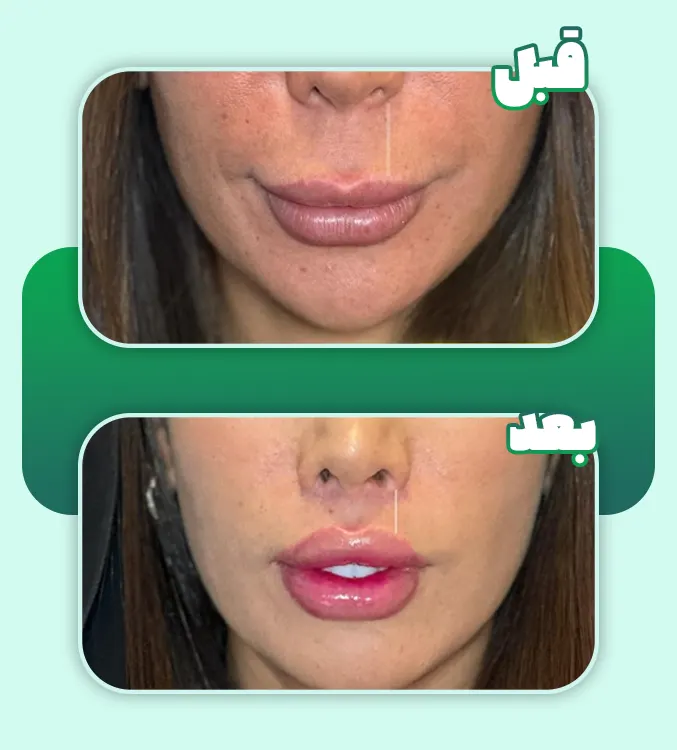 قبل و بعد سانترال لب