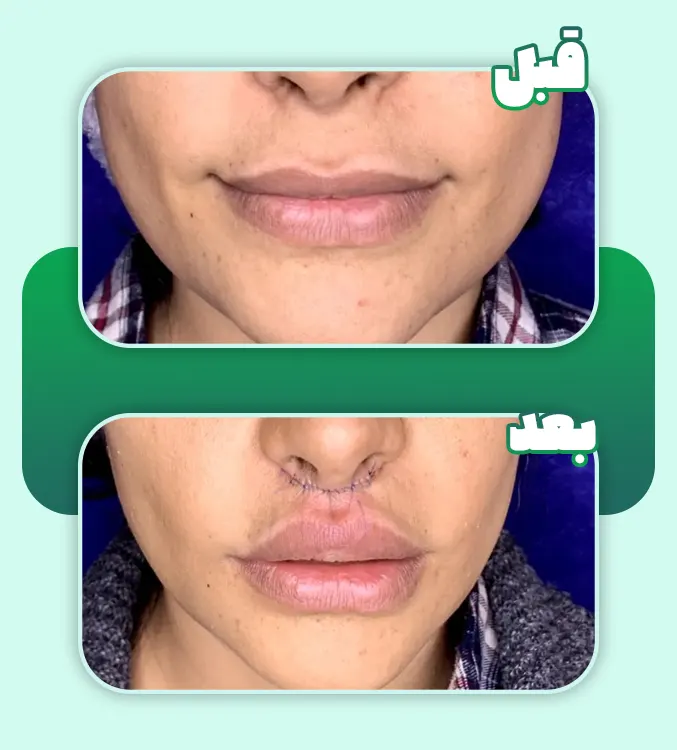 قبل و بعد سانترال لب