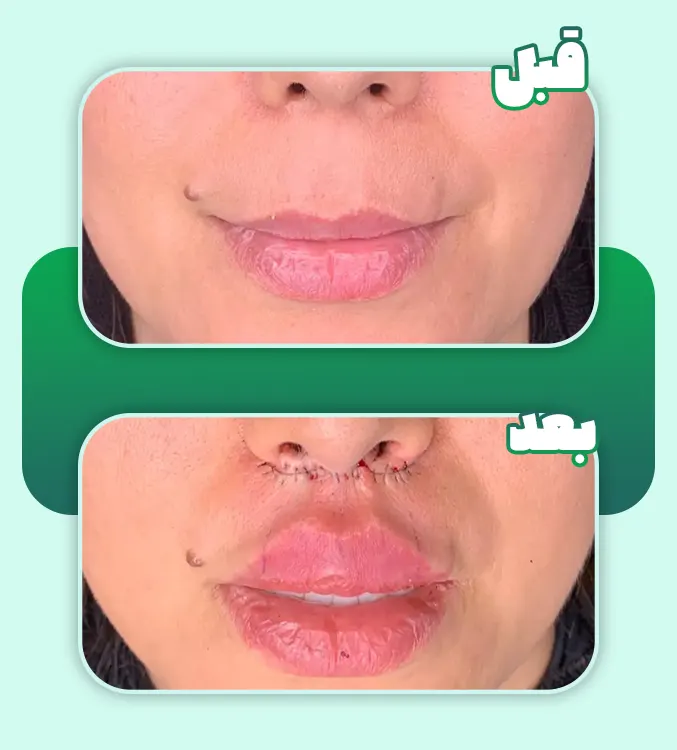 قبل و بعد سانترال لب