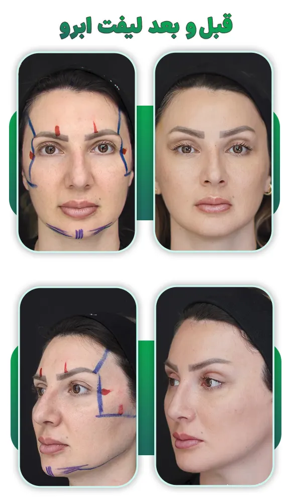 قبل و بعد لیفت ابرو
