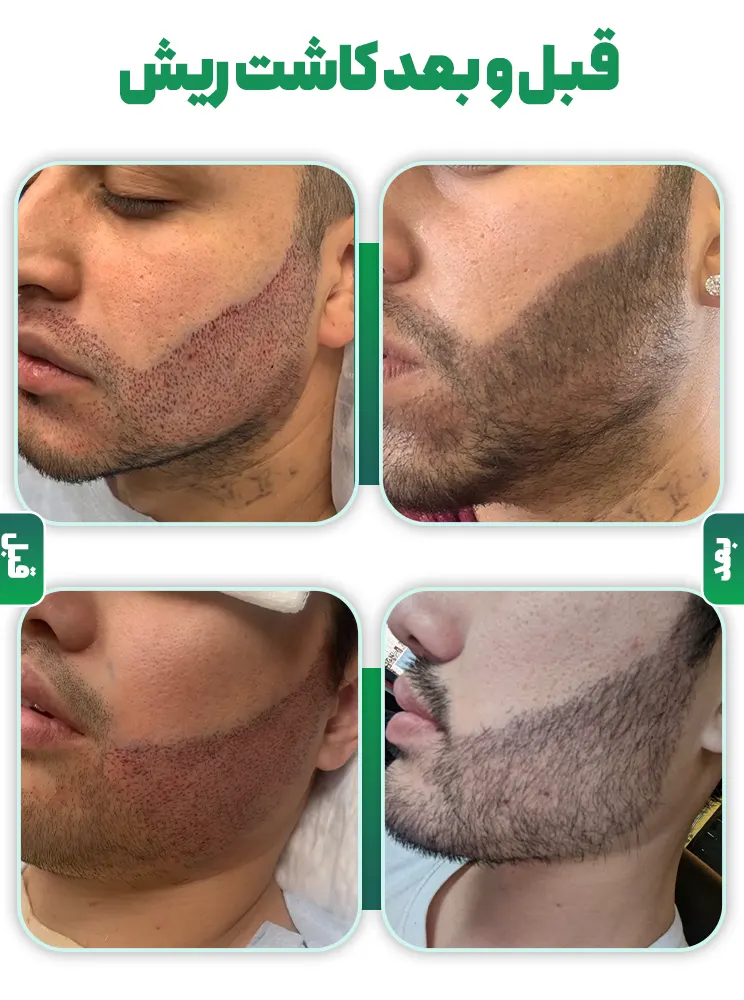 قبل و بعد کاشت ریش