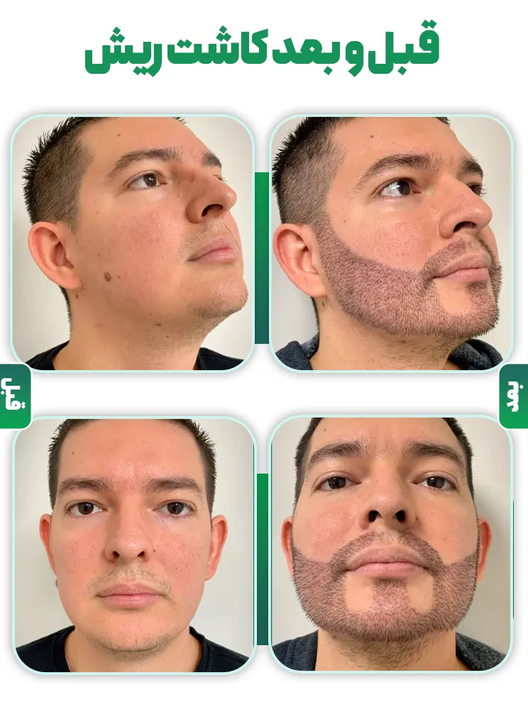 قبل و بعد کاشت ریش