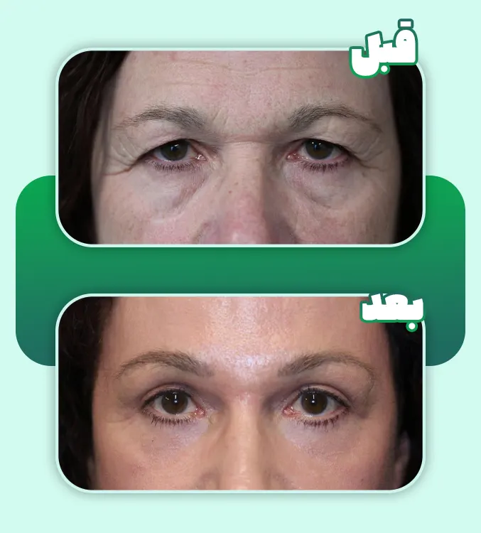 قبل و بعد لیفت ابرو