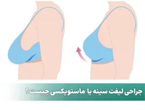 ماستوپکسی لیفت سینه