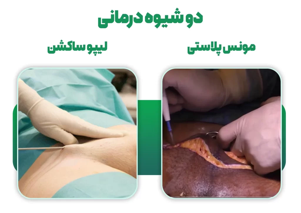 لیپوساکشن و مونس پلاستی