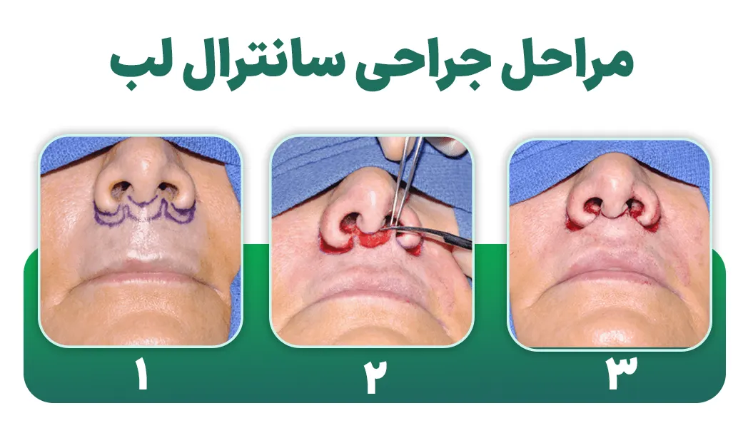 مراحل جراحی سانترال لب