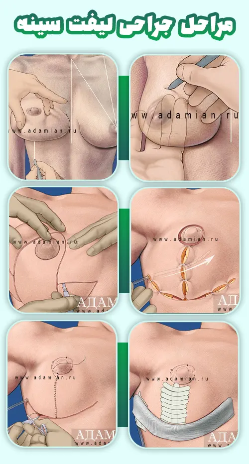 مراحل جراحی لیفت سینه