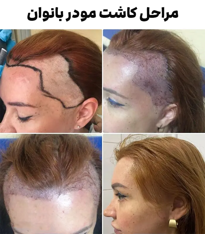 عکس های کاشت موی زنان + کاشت مو در زنان به چه صورت است