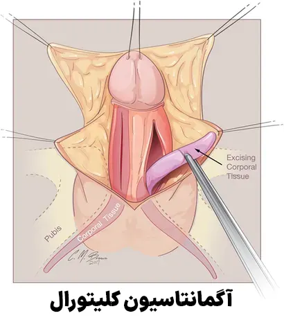 آگمانتاسیون کلیتورال