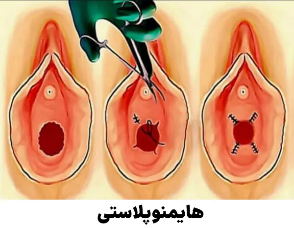 هایمنوپلاستی