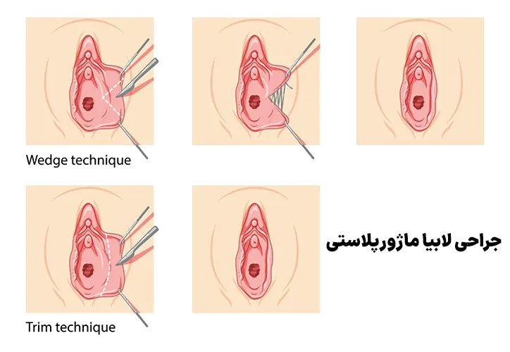 جراحی لابیا ماژورپلاستی