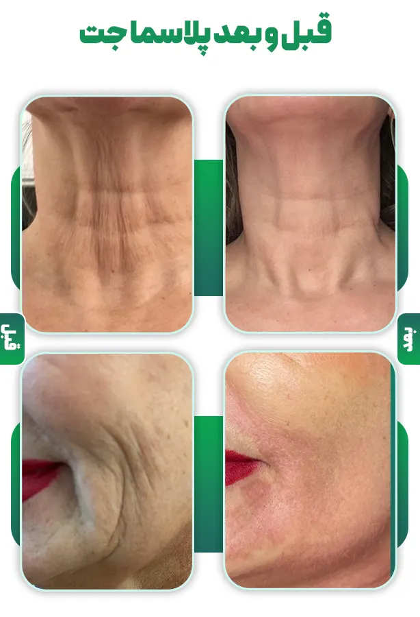 جوانسازی با پلاسما جت