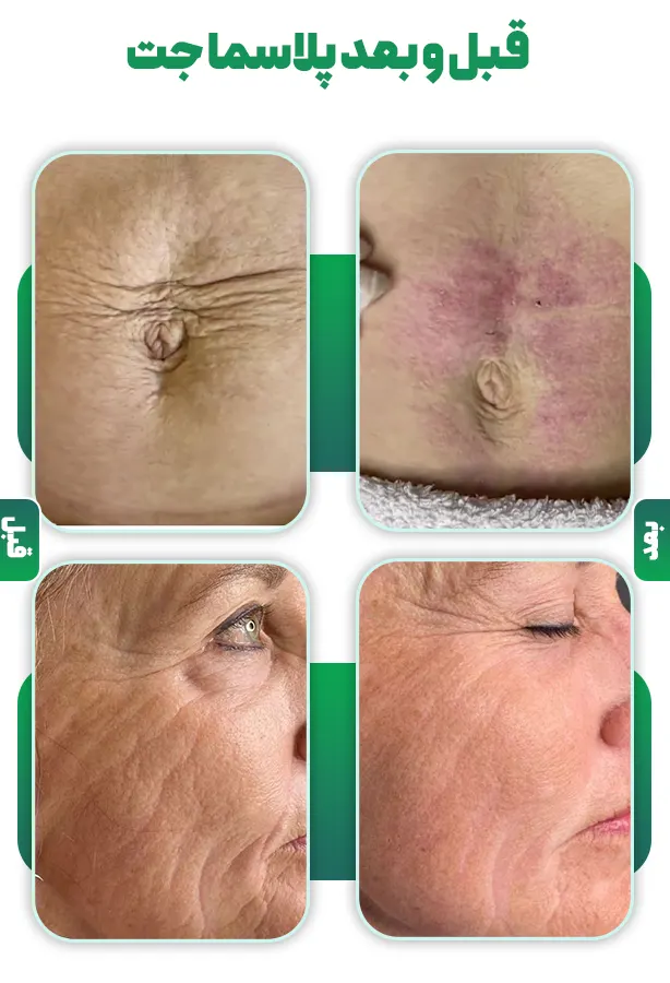 جوانسازی پوست با پلاسماجت