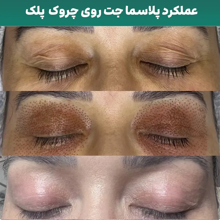 رفع چین چروک پلک با پلاسما جت