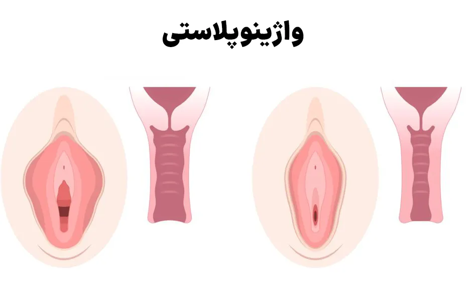 واژینوپلاستی