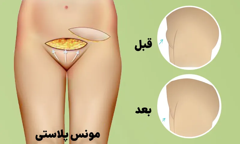 مونس پلاستی