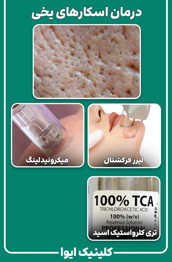 درمان اسکارهای یخی