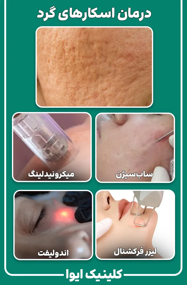 درمان اسکارهای گرد