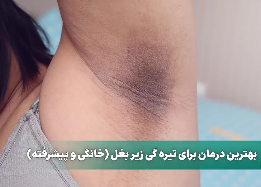 بهترین درمان برای تیره گی زیر بغل (خانگی و پیشرفته)
