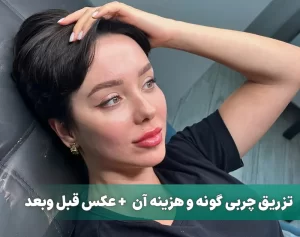 تزرق چربی گونه