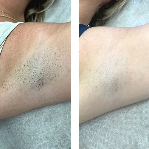 درمان تیرگی زیر بغل