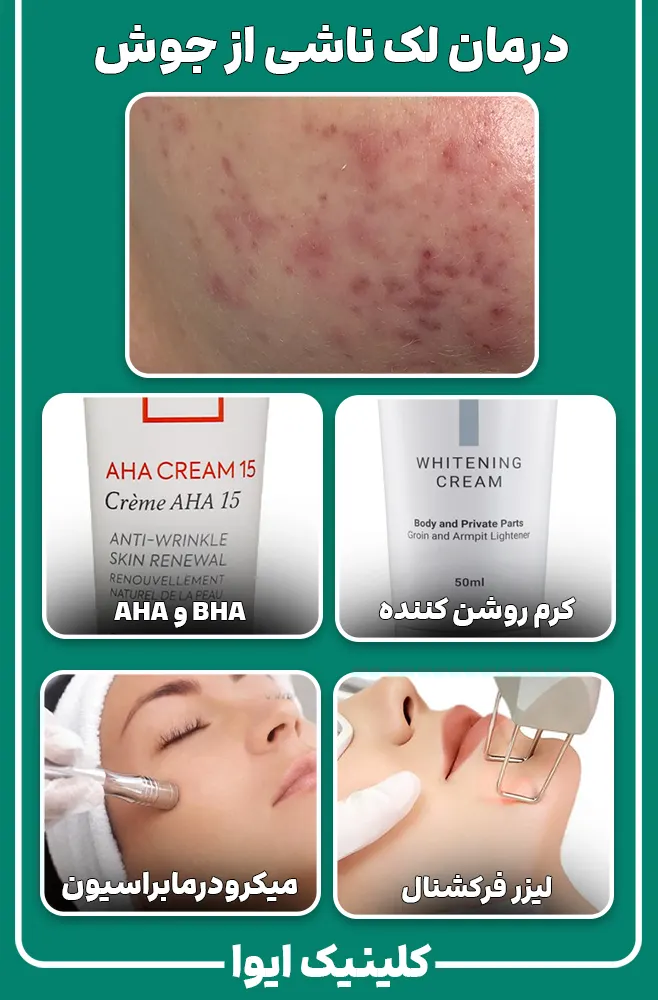 درمان لک جای جوش