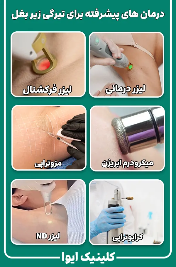 درمان های پیشرفته تیرگی زیر بغل