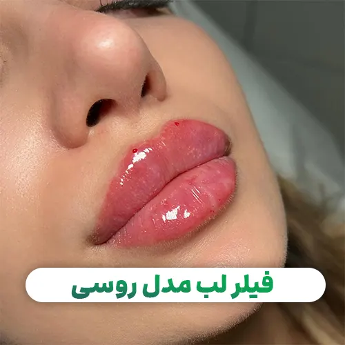 فیلر لب مدل روسی