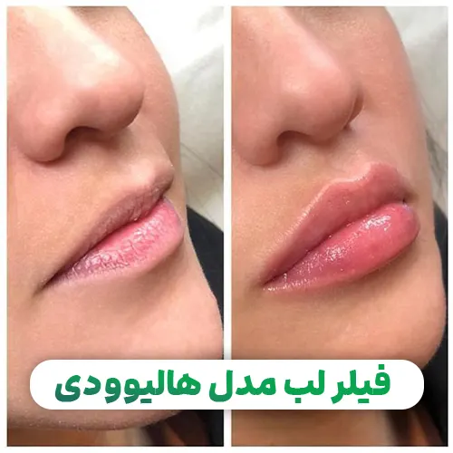فیلر لب مدل هالیوودی