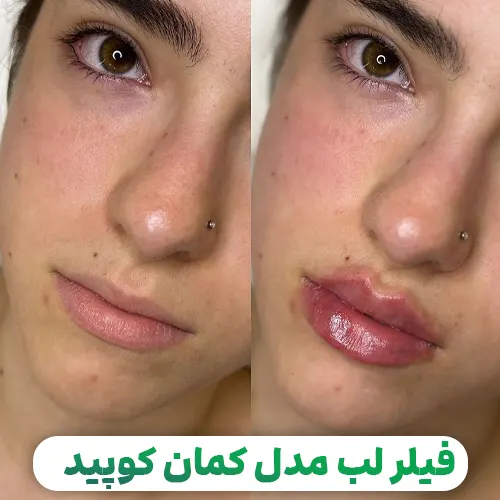فیلر لب مدل کمان کوپید