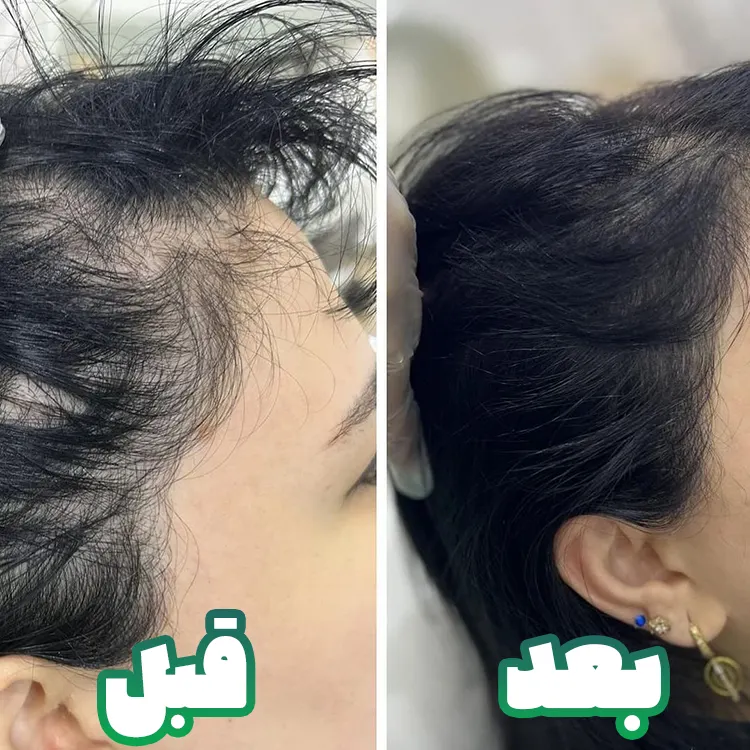 قبل بعد کاشت مو زنان