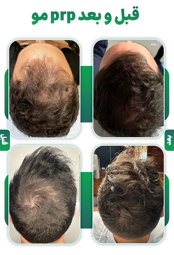 قبل و بعد prp مو