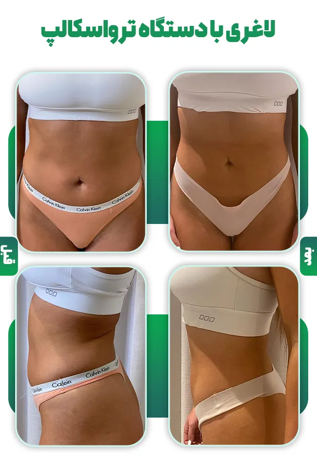 قبل و بعد ترواسکالپ