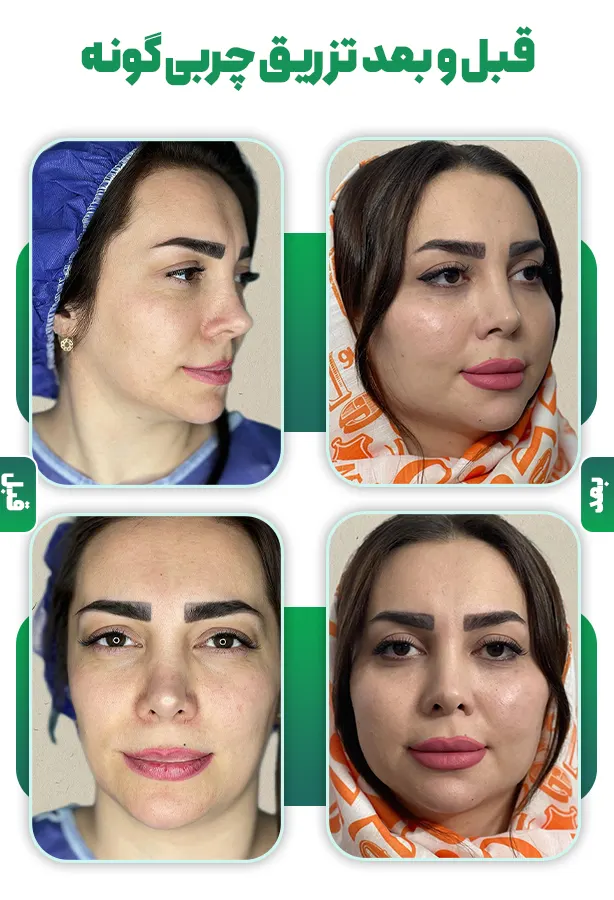 قبل و بعد تزریق چربی گونه