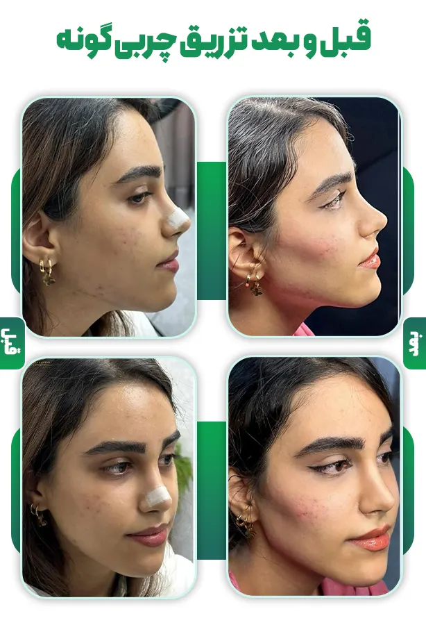 قبل و بعد تزریق چربی گونه