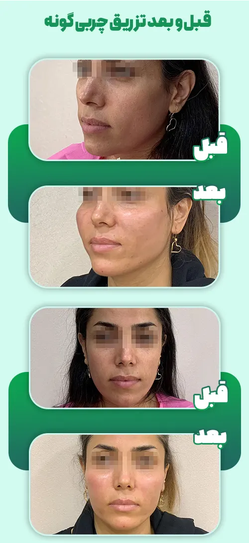 تزریق چربی گونه