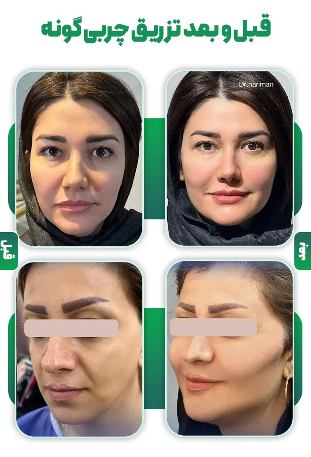 قبل و بعد تزریق چربی گونه
