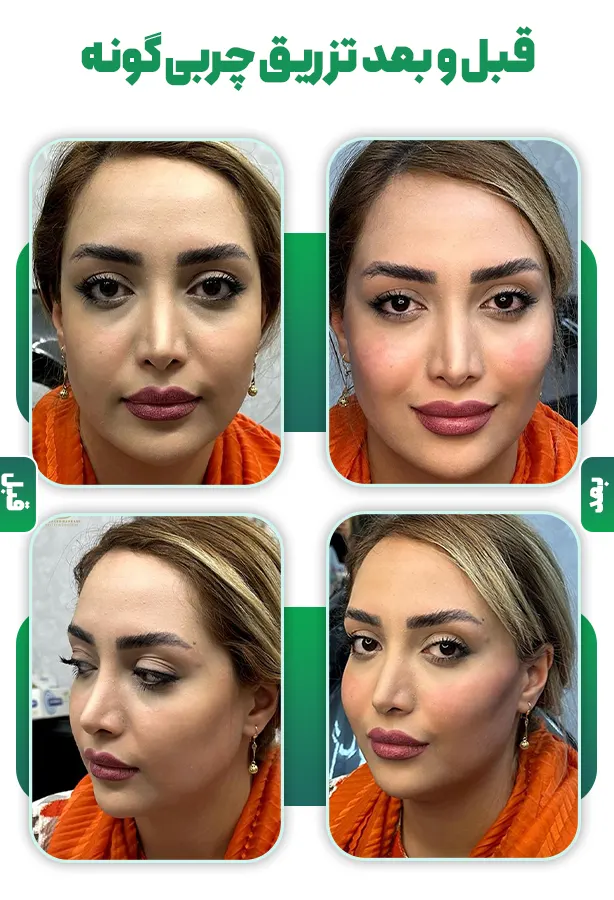 قبل و بعد تزریق چربی گونه