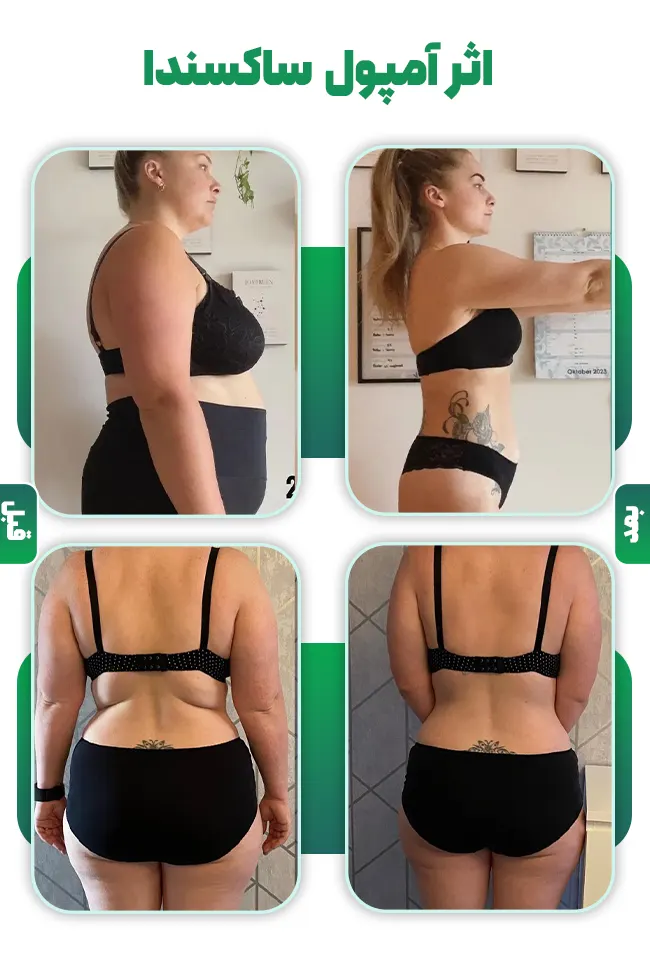 قبل و بعد ساکسندا