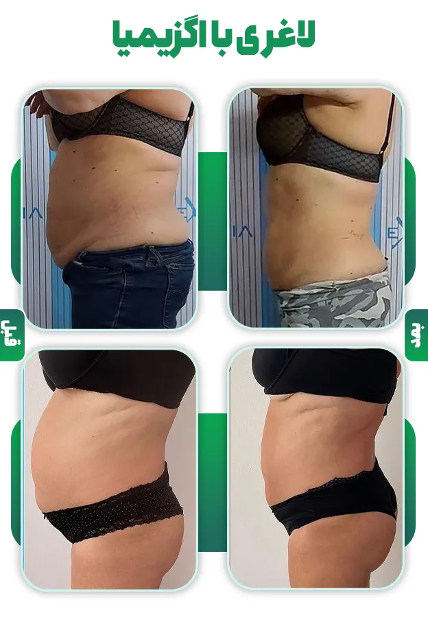 قبل و بعد لاغری با اگزیمیا